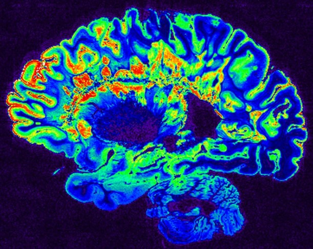 Side-view scan of a human brain on a dark-blue background; the cortical folds of the brain are colorized blue, light green, red, and yellow