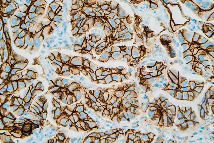 A breast cancer micrograph with positive cell-membrane staining