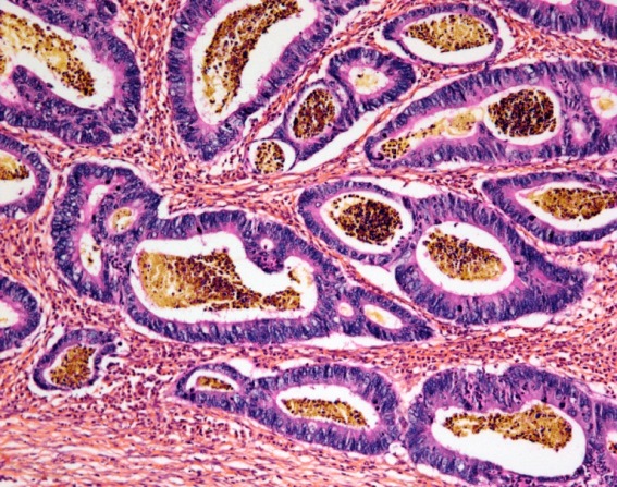 Micrograph showing a magnified slice through an adenocarcinoma of the colon; in the tissue, purple-stained tumor cells have organized into saclike structures, with mucinous material and inflammatory cells at their center