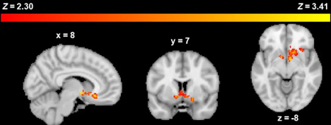three grayscale images of a human brain against a black background. The brain at left is viewed in profile, the brain is the middle is viewed from front to back, and the brain at right is viewed from bottom to top. A linear scale at the top of the image shows a band of color changing from red to yellow as you move left to right across a gradient. The left (red) side of the scale is labeled Z=2.30 and the right (yellow) side is labeled Z=3.41. Each brain has small, localized areas of red, orange, and yellow colors near the middle-bottom of the brain when viewed in profile, matching different portions of the colored linear scale at top. The left brain is labeled x=8, the middle brain is labeled y=8, and the right brain is labeled z= -8