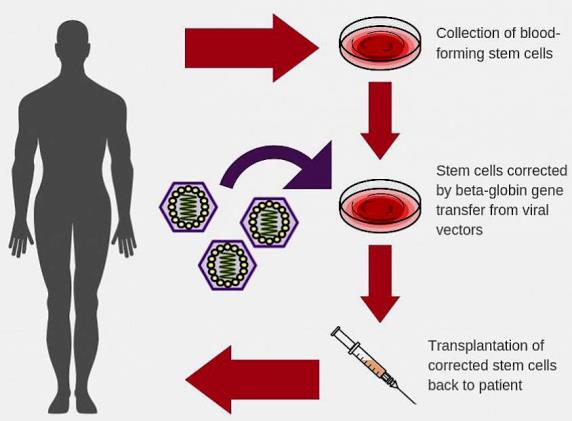 Illustration of a silhouette of an adult human body, and of three therapeutic steps (connected by arrows moving in a clockwise direction): (1) collection of blood-forming stem cells (a petri dish is shown); (2) stem cells corrected by beta-globin gene transfer from viral vectors (a petri dish and three viral vectors are shown); and (3) transplantation of corrected stem cells back to patient (a syringe is shown)