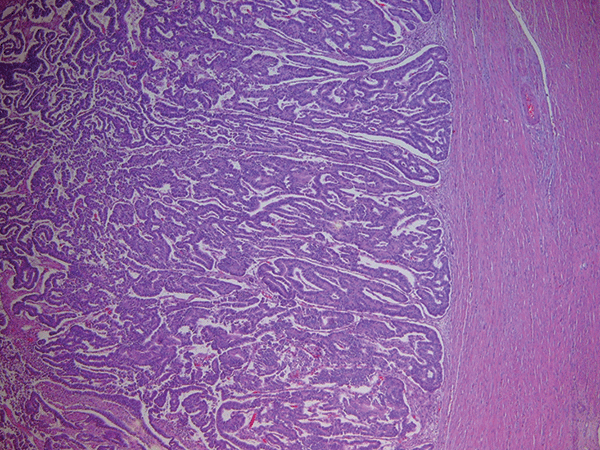 Thin section of an invasive endometrial tumor, with purple staining showing the complexity of the glands. 