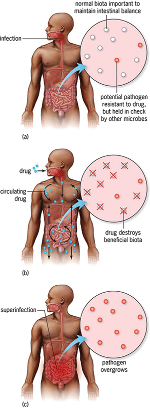 Three diagrams of a human male body and a petri dish used to illustrate the development of a superinfection; the top illustration shows a case with normal biota; the middle illustration shows a case in which the drug destroys beneficial biota; and the bottom illustration shows a case in which the pathogen overgrows.