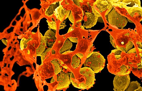 Spheroid-shaped MRSA bacteria (colored yellow) amongst orange-colored cellular debris