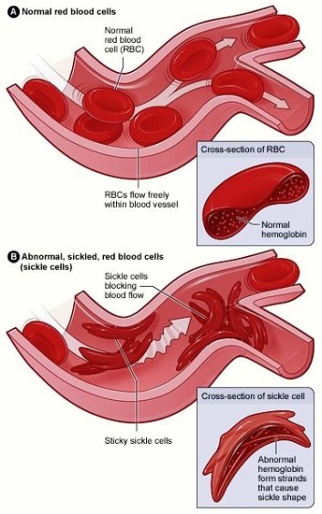 Illustration showing the differences between normal and sickled red blood cells