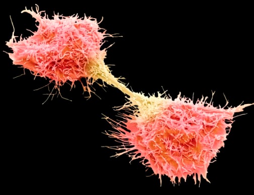Colored SEM (pink and yellow) of dividing fibrosarcoma cells