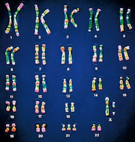 The chromosomes of an individual with Down syndrome
