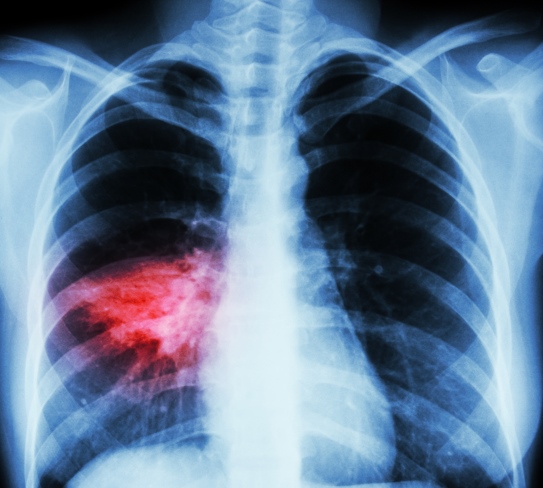 Chest x-ray showing consolidation in the right lung