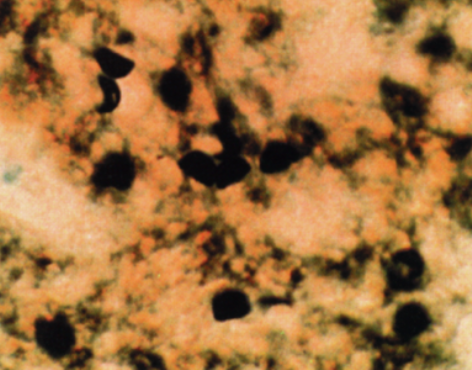 Black cysts of Pneumocystis jirovecii on a tan background