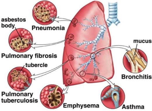 Illustration of a lung, with smaller insets showing some disorders (pneumonia, pulmonary fibrosis, pulmonary tuberculosis, emphysema, asthma, and bronchitis)