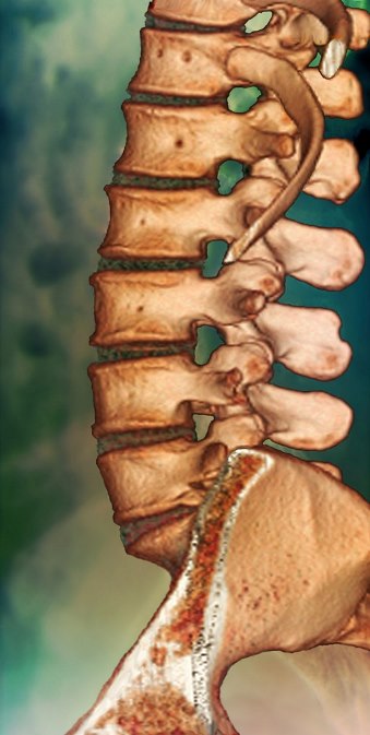 Close-up side view of a colored CT scan of the lower spine of an adult human