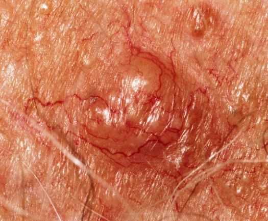 Close-up color photo of a basal cell carcinoma on skin