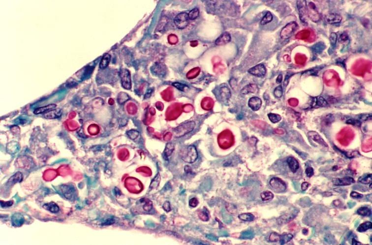 Inflammatory cells and yeast cells (stained red) in a lung